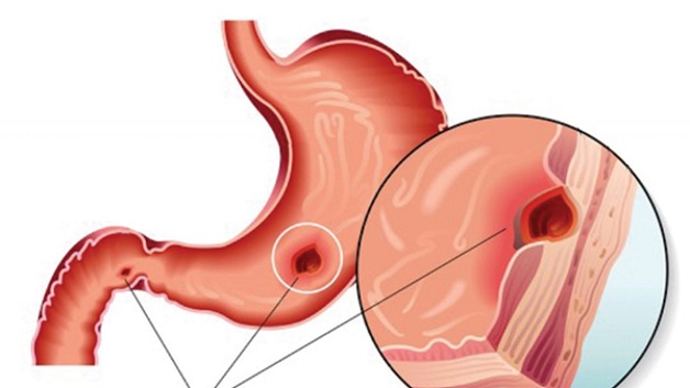 Giải đáp thắc mắc về viêm niêm mạc dạ dày