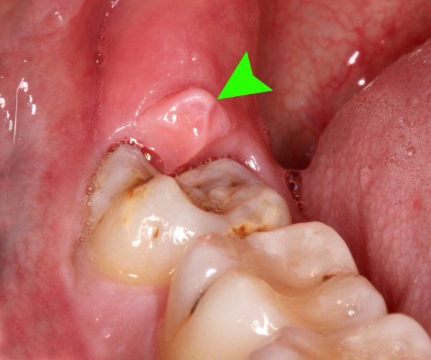 Giải đáp thắc mắc: Viêm lợi trùm có tự khỏi được không?