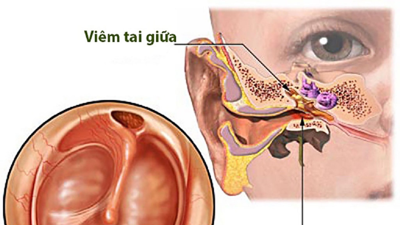 Giải đáp thắc mắc: Viêm tai giữa uống thuốc gì?