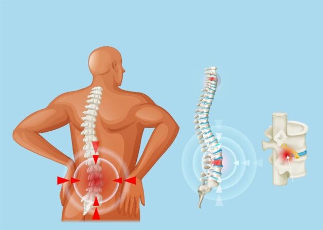 Giải đáp: thoát vị đĩa đệm là đau ở đâu