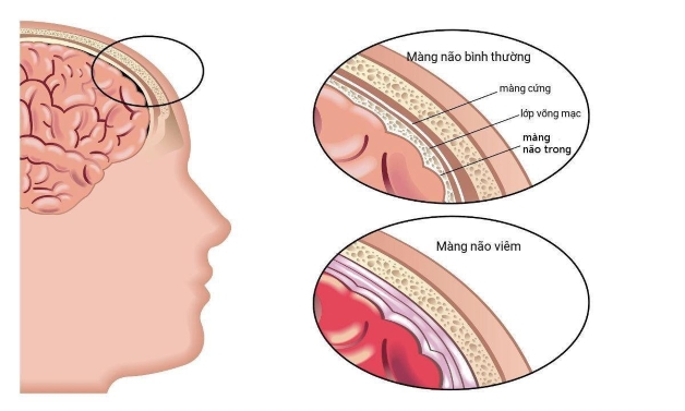 Giải đáp: Tiêm phế cầu sốt mấy ngày?