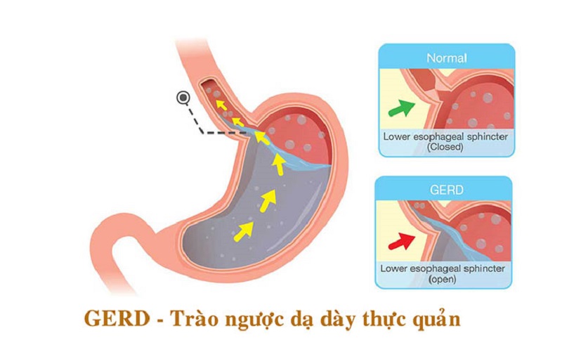 trao nguoc da day thuc quan va dinh duong