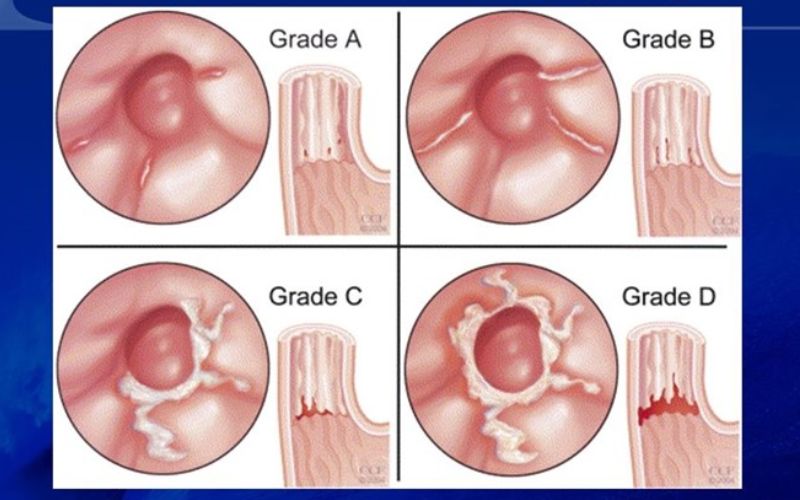 Giải đáp: Trào ngược dạ dày cấp độ A có nguy hiểm không?