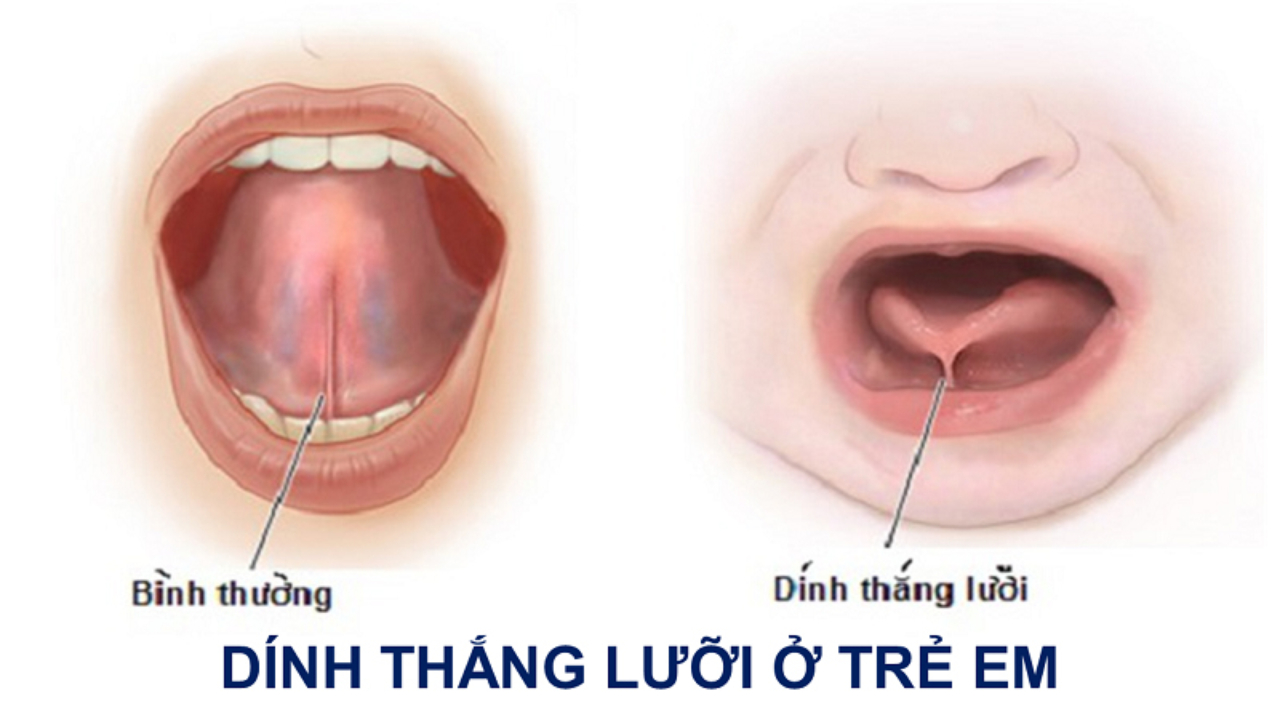 Giải đáp: Trẻ bị dính thắng lưỡi phải làm sao?