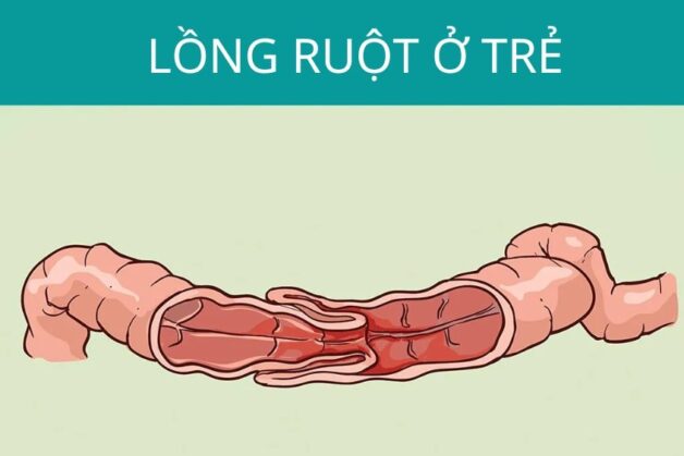 Giải đáp: Trẻ bị kiết lỵ, nên và không nên ăn gì?