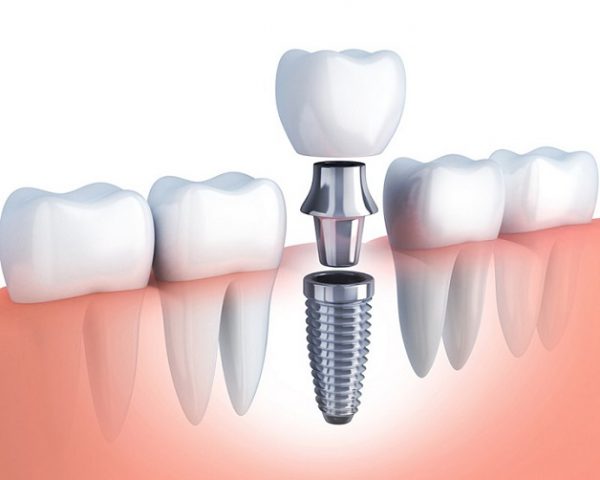 GIẢI ĐÁP: Trồng răng giá bao nhiêu? 