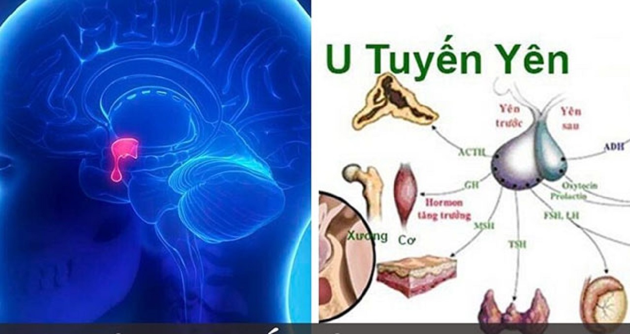 Giải đáp: U tuyến yên biểu hiện thế nào?