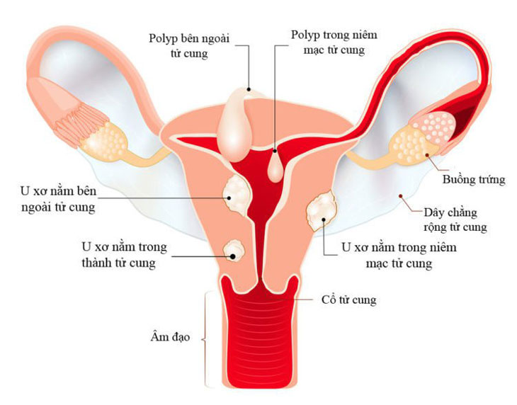 Giải đáp: U xơ tử cung kích thước bao nhiêu thì mổ?