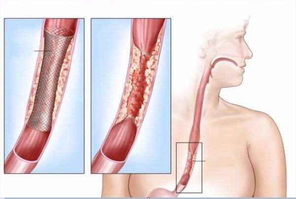 Giải đáp: Ung thư thực quản có chữa được không?