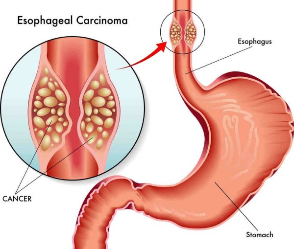 Giải đáp: Ung thư thực quản sống được bao lâu?