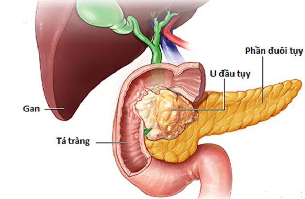 Giải đáp: Ung thư tụy có nguy hiểm không?