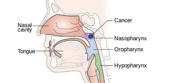 Giải đáp: Ung thư vòm họng có chữa được không