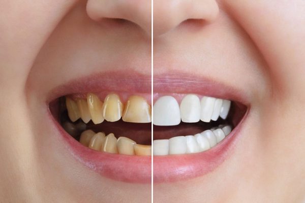 Giải đáp: Ưu điểm của dán sứ veneer là gì?