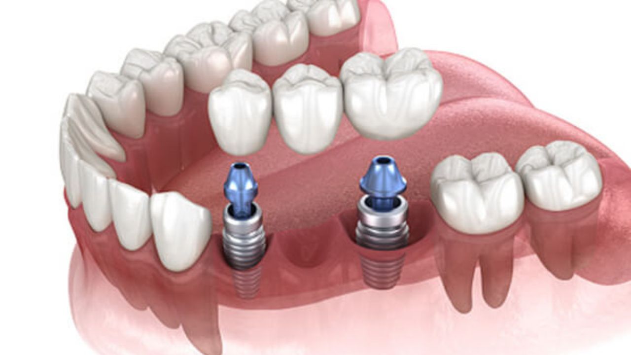 Giải đáp vấn đề: Trồng răng sứ có đau không