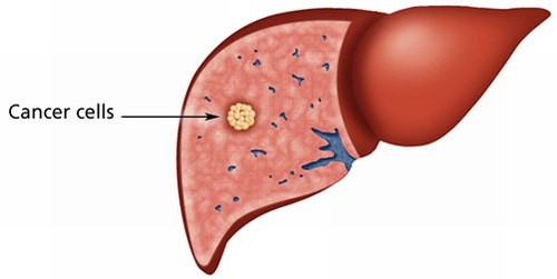 Giải đáp về bệnh u gan dọa tính mạng người bệnh