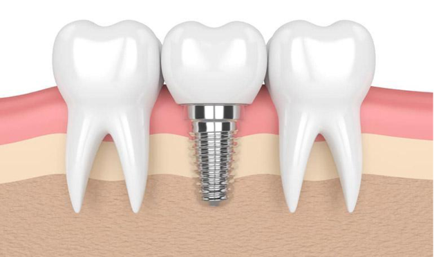 Giải đáp về trồng răng sứ có đau không