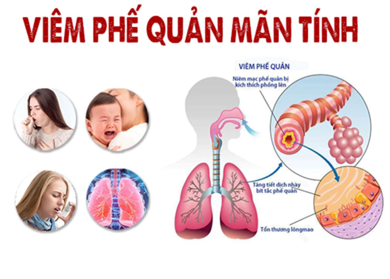 Giải đáp viêm phế quản mãn tính là gì, cách điều trị cho trẻ em