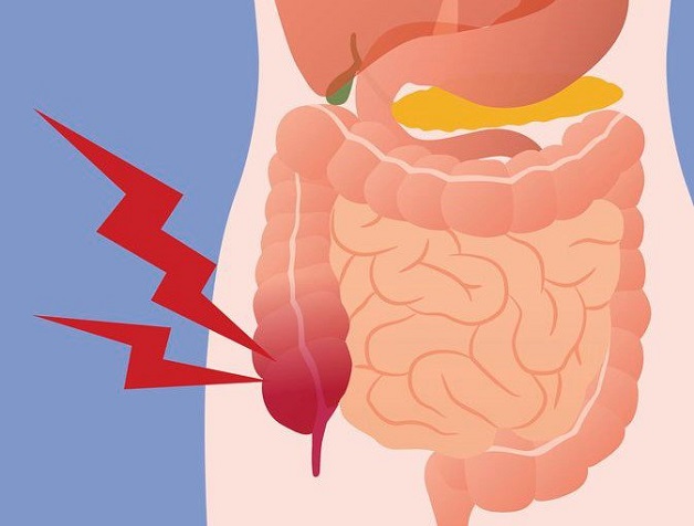 Giải đáp viêm ruột thừa có nguy hiểm không?