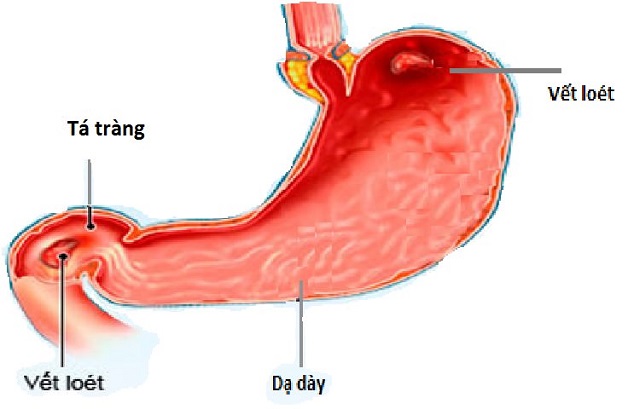 Giải đáp viêm tá tràng có nguy hiểm không?