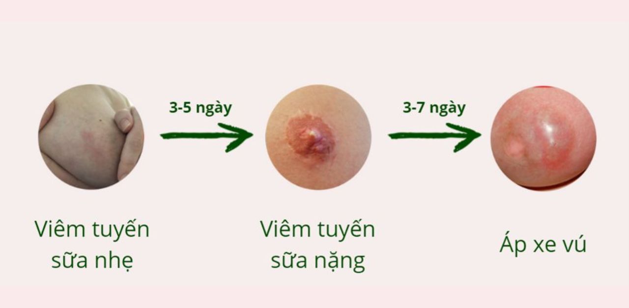 Giải đáp viêm tuyến vú có nguy hiểm không?