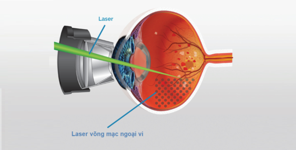 Giải đáp võng mạc non vùng 1 là gì và bệnh võng mạc trẻ sinh non