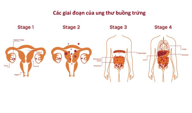 Giai đoạn và phương pháp điều trị ung thư buồng trứng