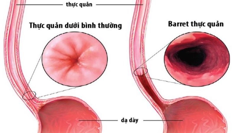 “Giải mã” chứng khó nuốt khi ăn và cách chẩn đoán