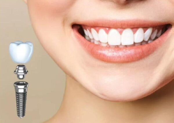 Giải mã những yếu tố tác động đến bảng giá trồng răng Implant