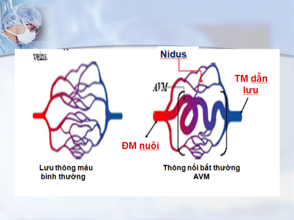 Giải pháp cho bệnh nhân dị dạng động tĩnh mạch