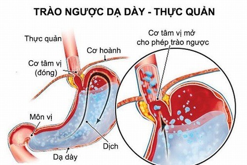 Giải pháp cho người bệnh trào ngược dạ dày thực quản