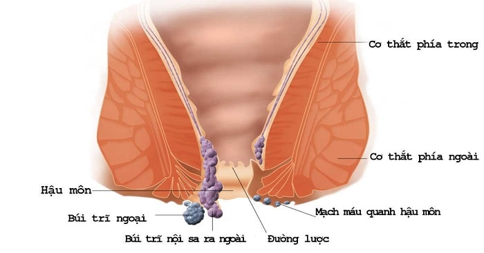 Giải tỏa nỗi lo bị trĩ khi mang thai