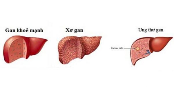 Giải tỏa nỗi lo về chi phí khám bệnh gan tại Thu Cúc