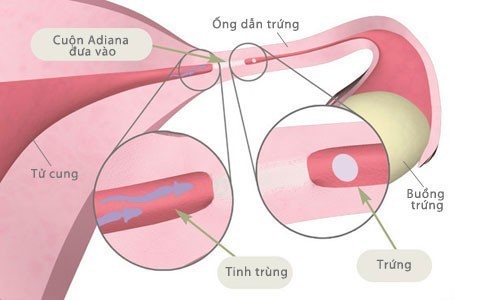 GIẢM THIỂU NGUY CƠ HIẾM MUỘN TỪ VIÊM ỐNG DẪN TRỨNG