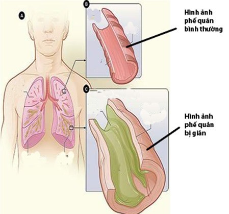 Giãn phế quản có biểu hiện gì?