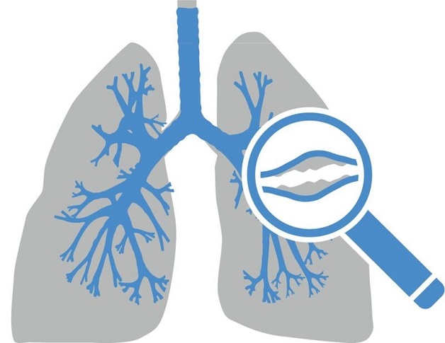 Giãn phế quản: Những điều cần biết