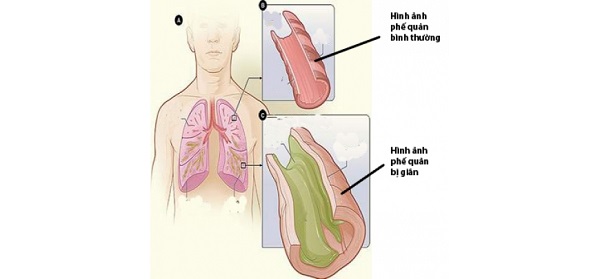 Giãn phế quản thể khô là gì?