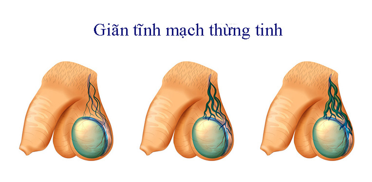 Giãn tĩnh mạch thừng tinh có nguy hiểm không?