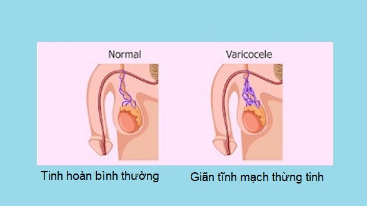 Giãn tĩnh mạch thừng tinh ở trẻ em có nguy hiểm không?