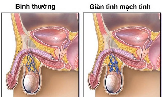 Giãn tĩnh mạch tinh hoàn: Nguyên nhân, triệu chứng và chữa trị