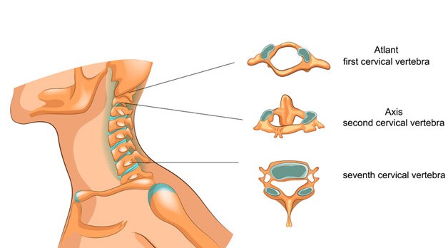 Giới thiệu những cách trị gai đốt sống cổ không phẫu thuật