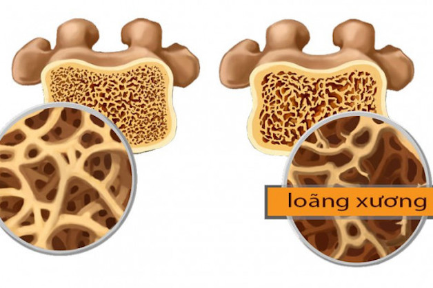 Giúp bạn hiểu đúng về bệnh loãng xương độ 3