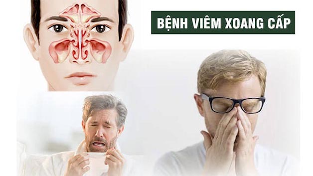 Giúp bạn hiểu rõ về căn bệnh viêm xoang mũi cấp