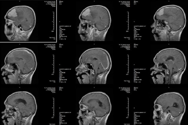 Giúp bạn hiểu rõ về kỹ thuật chụp CT sọ não