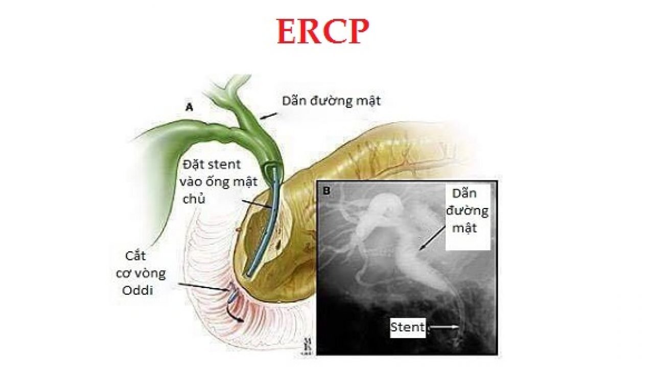 Giúp bạn hiểu rõ về kỹ thuật nội soi mật tụy ngược dòng