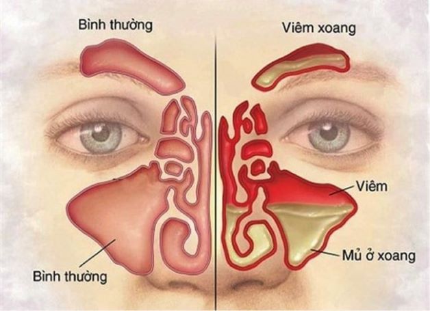 Giúp bạn hiểu rõ về phẫu thuật xoang mũi