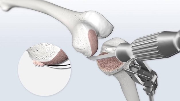 Giúp bạn nắm rõ thay khớp gối có nguy hiểm không