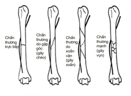 Giúp bạn xử lý nhanh chóng khi bị gãy xương cánh tay