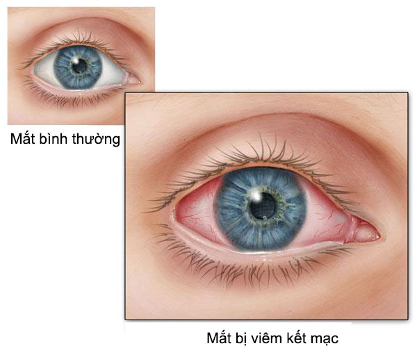 Giúp mẹ nhận biết dấu hiệu bệnh viêm kết mạc mắt ở trẻ nhỏ