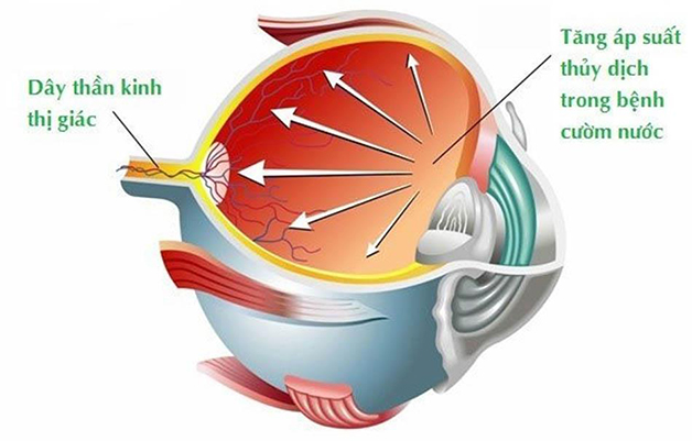 Glocom góc mở: Nguyên nhân, triệu chứng và cách điều trị