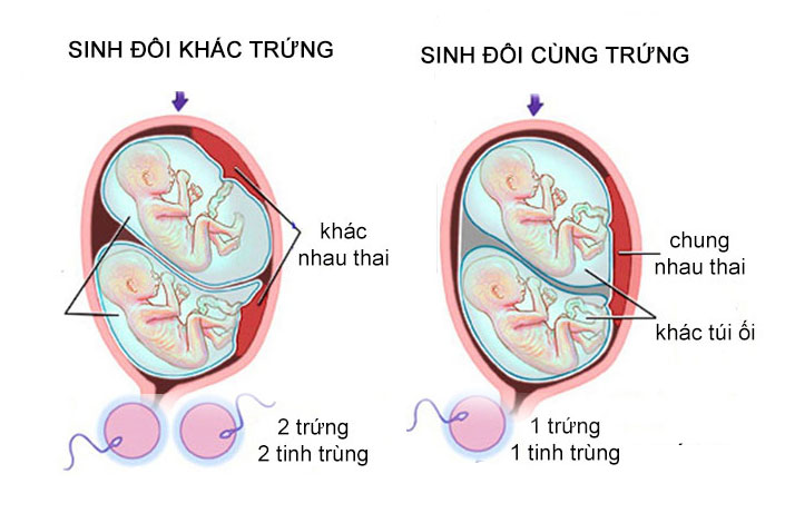 Góc chia sẻ: Kinh nghiệm mang thai đôi mẹ bầu cần lưu ý